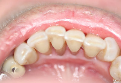 Шиниране на зъби с влакно G.C perio