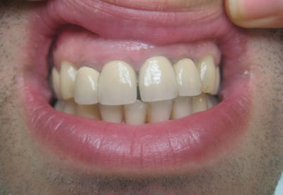 Металокерамика фронт след подмяна на стари корони