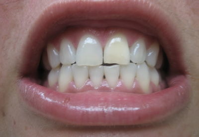 Избелване на зъби с шини