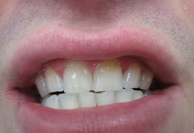 Избелване на зъби в домашни условия с шини