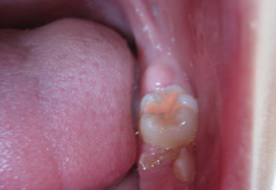 Силанизиране на фисури