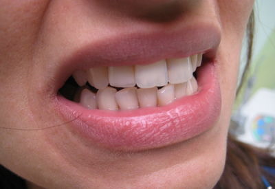 Керамична корона на страничен резец