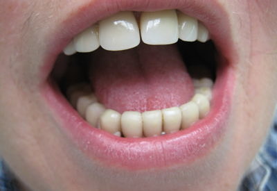 Частична еластична олекотена протеза Bio Dentaplast на Bredent