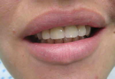 Естетични керамични корони на фронталните зъби Емах