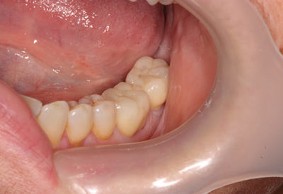 Естетични корони от керамика(без метал) на дъвкателни зъби