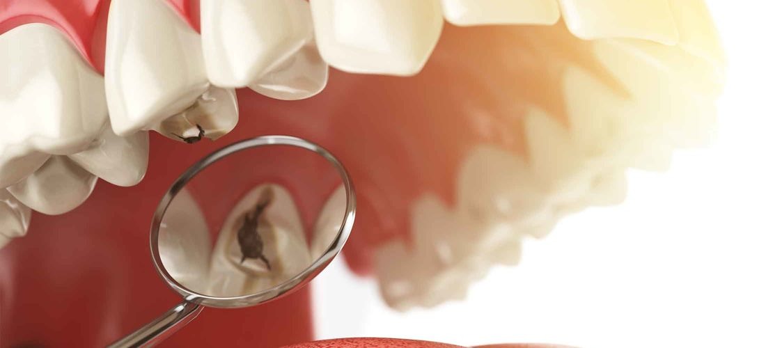 Защо се появява кариес ?