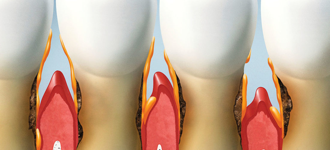 Връзката межу пародонтoзата и другите заболявания в организма