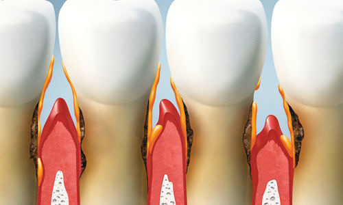 Връзката межу пародонтoзата и другите заболявания в организма
