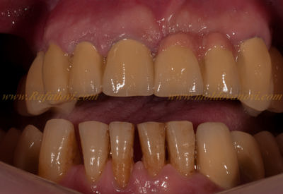 Металокерамичен мост със стъклена опора ZX-27